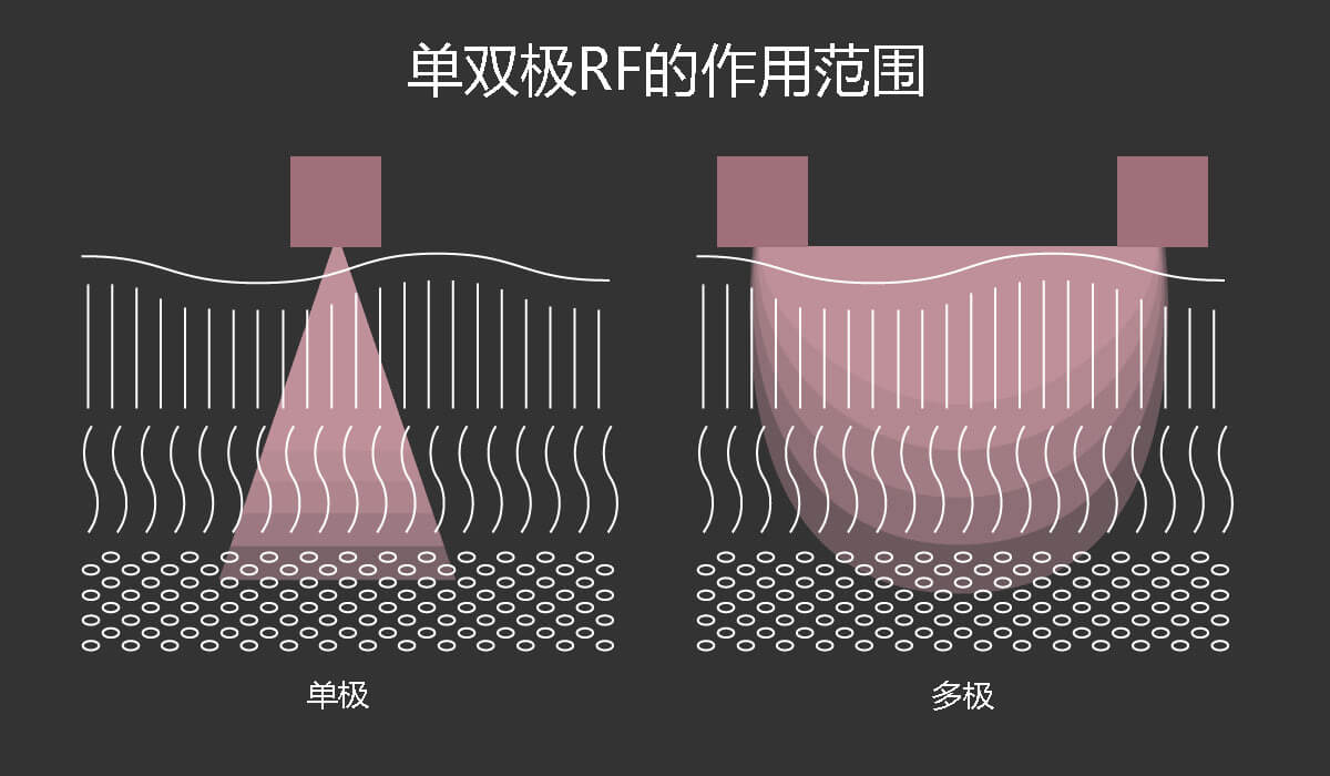 单双极射频的作用范围