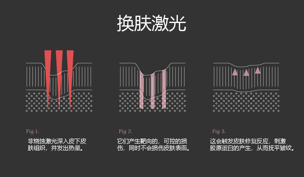换肤激光原理