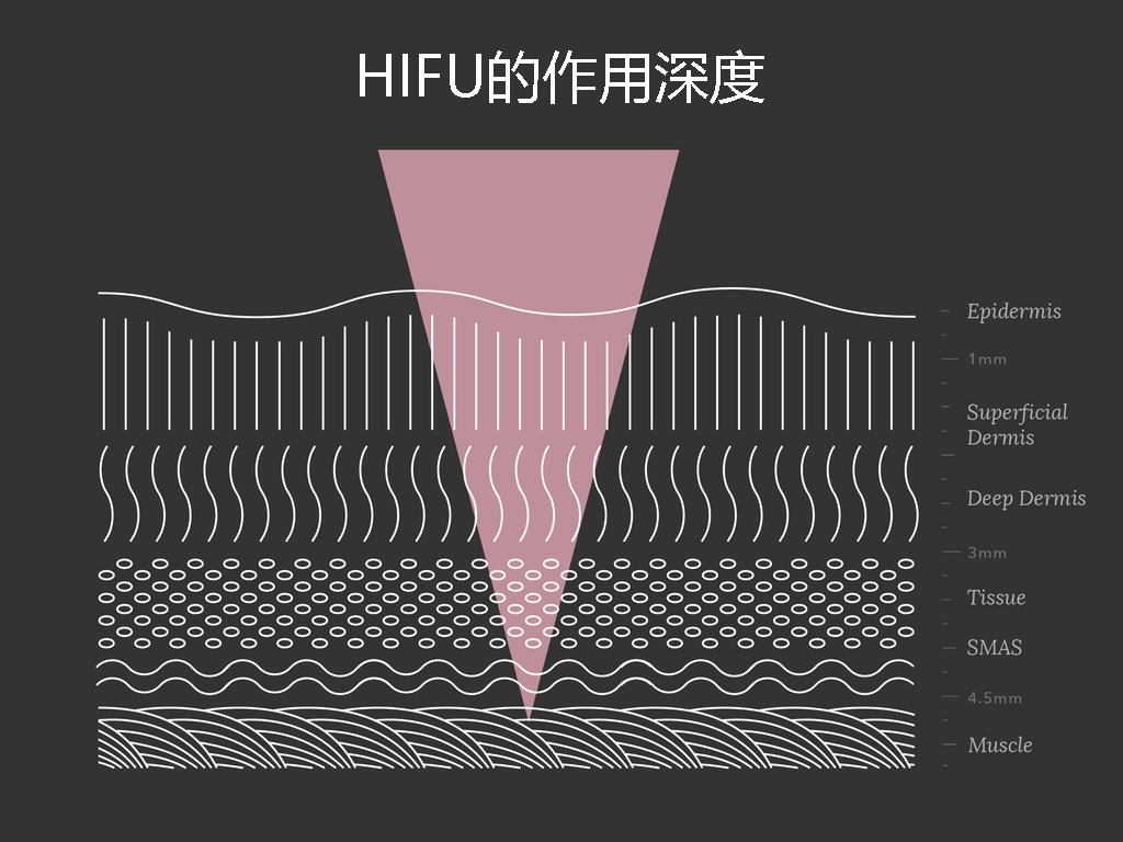 HIFU的作用深度